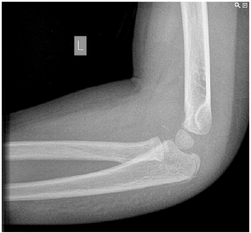 Lateral elbow radiograph showing displaced olecranon fracture