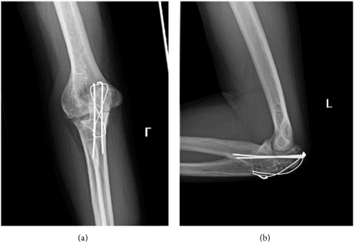 Olecranon fracture nonunion after tension band wiring