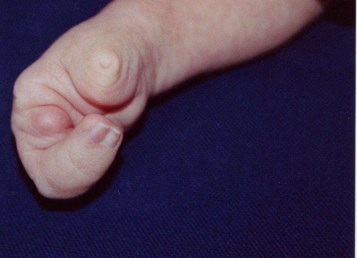 Hand with absent central digits producing a deep V-shaped cleft between the remaining border rays.