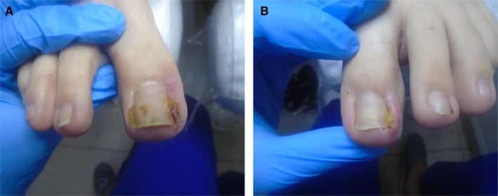 Advanced bilateral great-toe onychocryptosis with hypertrophic inflamed nail folds