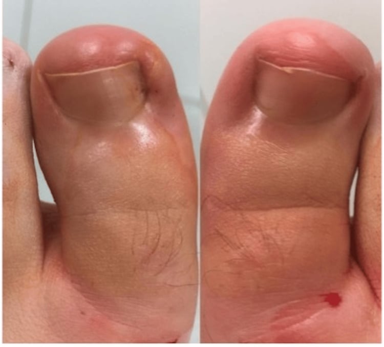 Bilateral great-toe onychocryptosis with lateral nail-plate impingement and localised nail-fold inflammation