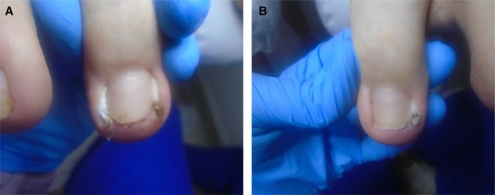 Cotton tamponade placed beneath the lateral edge of an ingrown great toenail