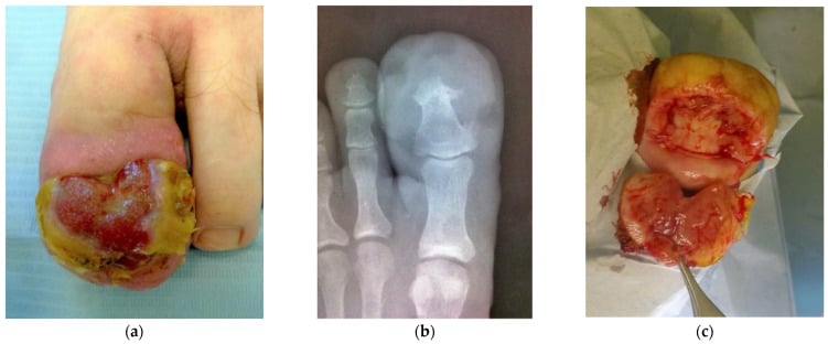 Ulcerated periungual lobular capillary haemangioma with toe radiograph and excised specimen