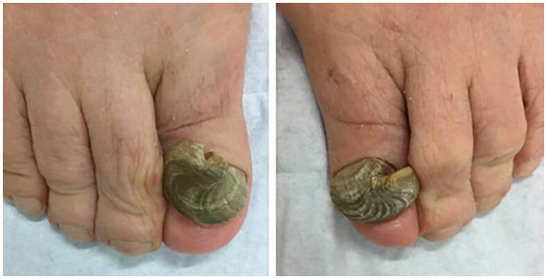 Bilateral onychogryphosis with grossly thickened curved ram-horn great toenails