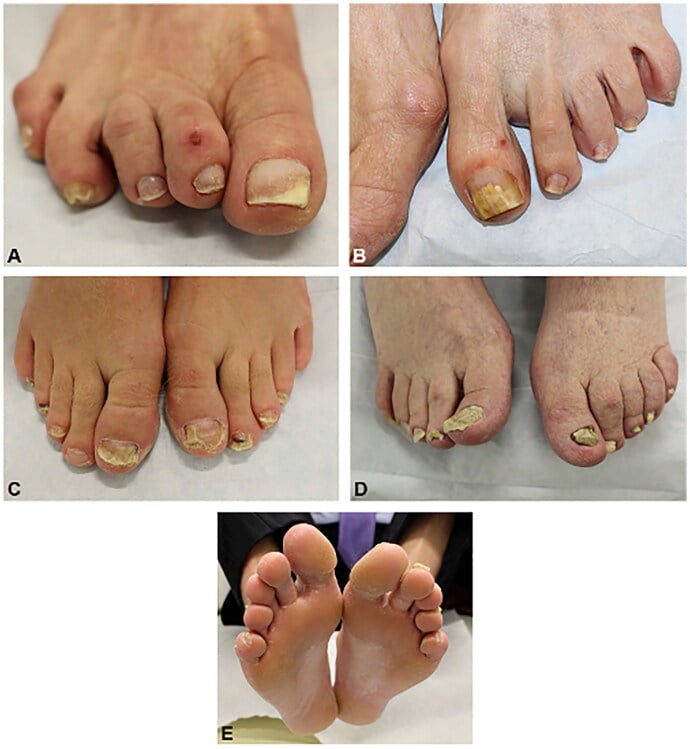 Clinical patterns of toenail onychomycosis including yellow discoloration, subungual hyperkeratosis and onycholysis