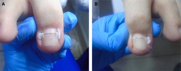 Orthonyxia brace applied across a curved great toenail with lateral tamponade