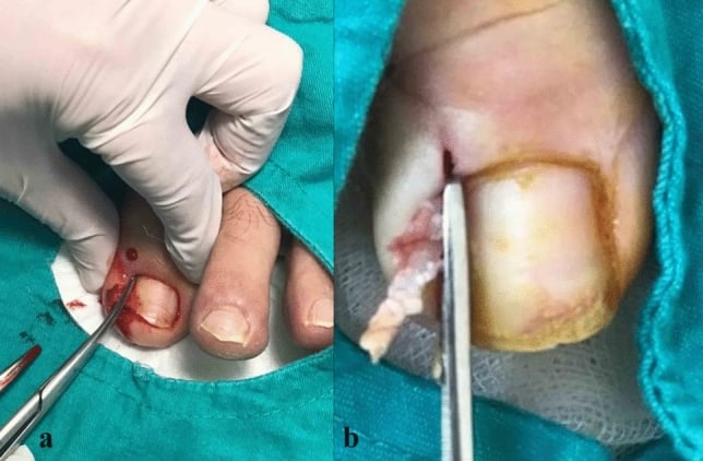 Longitudinal excision of the diseased lateral nail strip to the germinal matrix