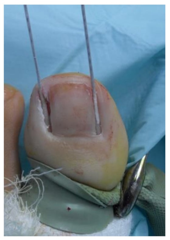 Phenol-soaked applicators placed against both exposed lateral matrix horns