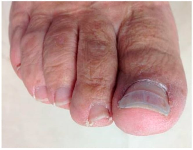 Polyethylene gutter splint placed along the lateral edge of an ingrown great toenail