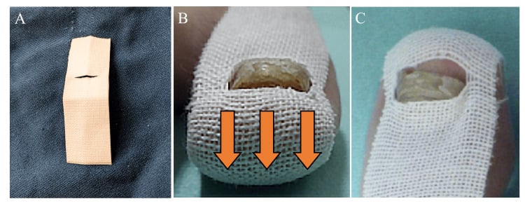Stepwise slit-tape strap technique pulling the distal toe pulp away from the nail edge