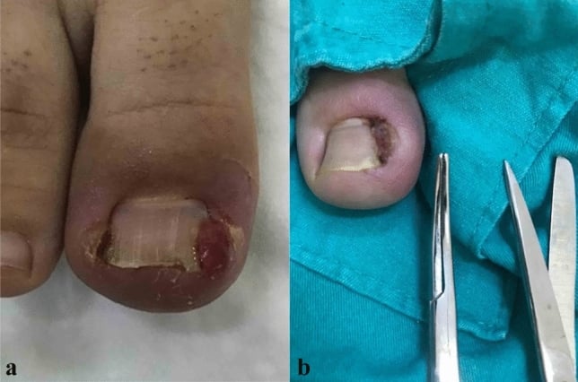 Stage III ingrown great toenail with exuberant lateral granulation tissue