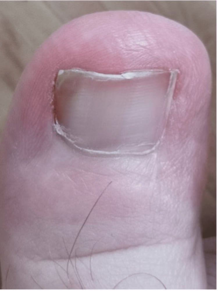 Twelve-month appearance after Winograd procedure with a healed lateral fold and narrowed nail plate