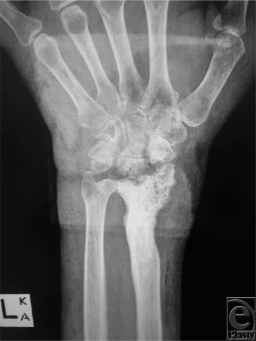 Plain radiograph of the forearm showing osteolysis, sequestrum, involucrum and periosteal reaction in chronic osteomyelitis