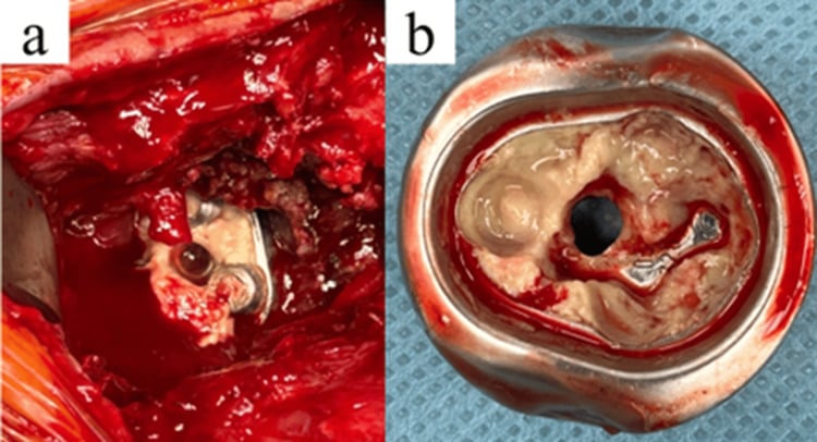 Intraoperative view showing purulent tissue around a shoulder arthroplasty baseplate