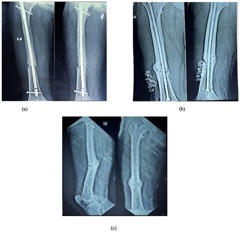 Serial radiographs of an infected nonunion treated with an antibiotic-coated locking nail