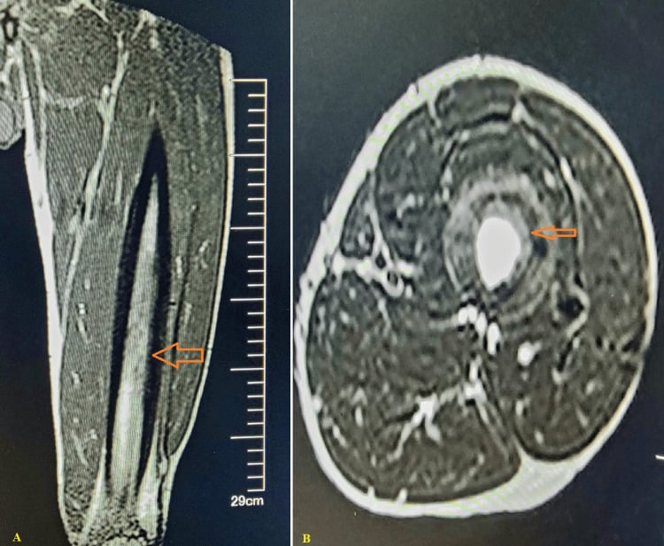 Sagittal T1 and axial T2 MRI of the femur showing marrow signal change and an intramedullary collection