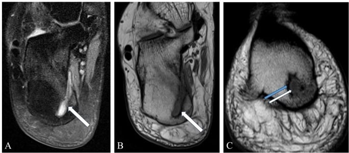 MRI of the calcaneus showing a T2 hyperintense, T1 hypointense abscess