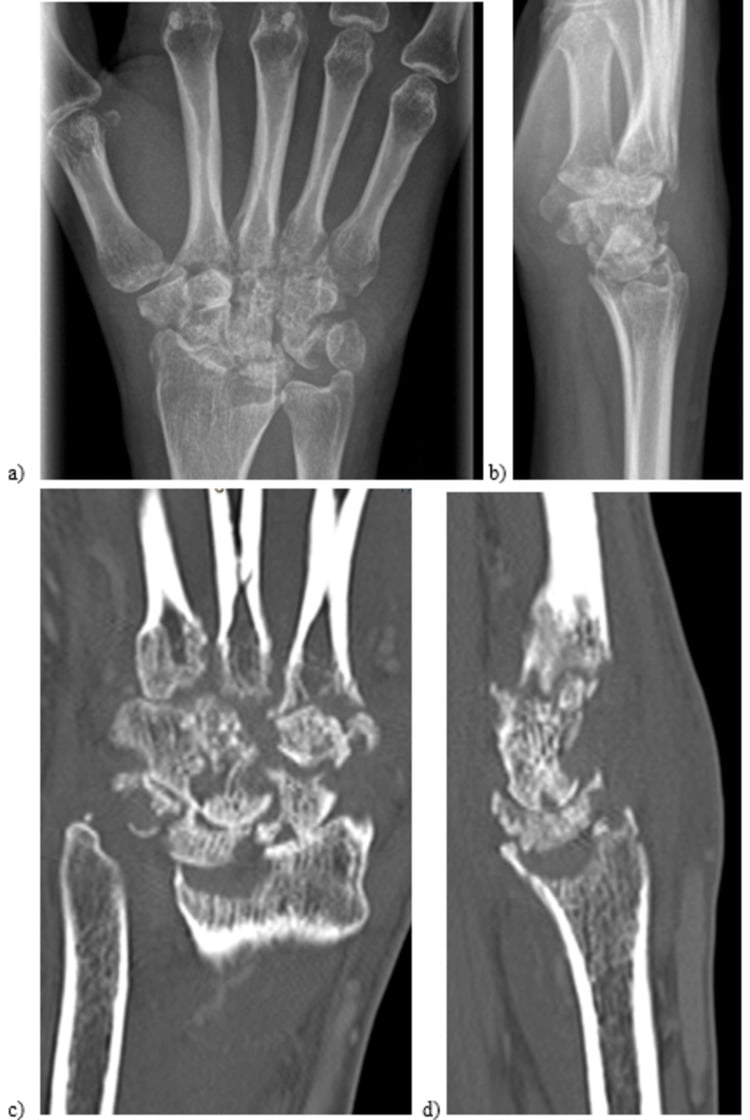 Radiograph showing erosive destruction of the carpus and radiocarpal joint in septic arthritis