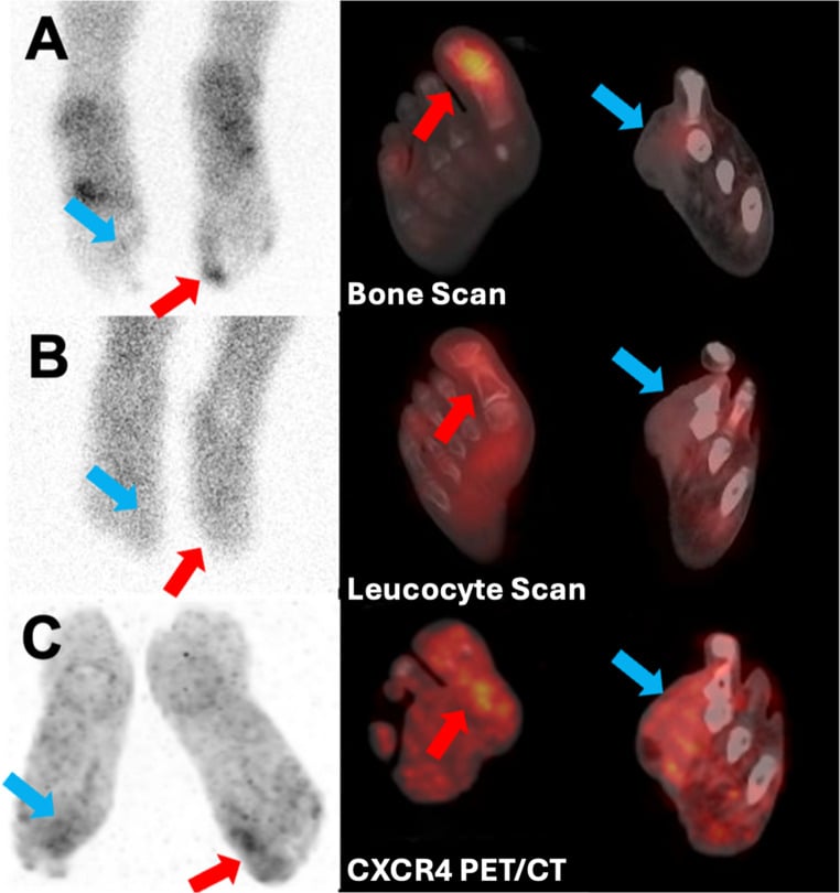 Bone scan, labelled leucocyte scan and CXCR4 PET compared in diabetic foot infection