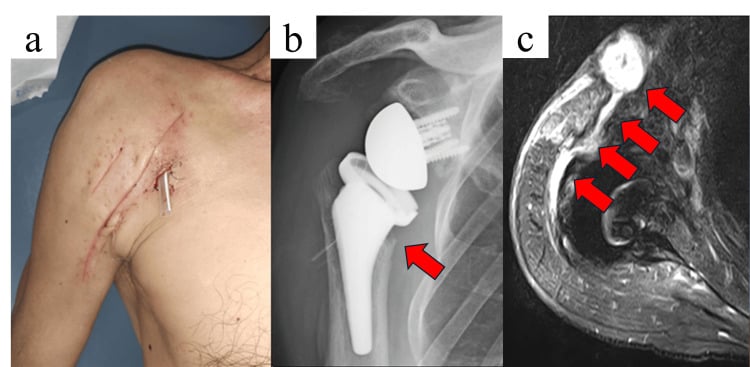 Clinical photograph, radiograph and MRI of periprosthetic shoulder infection with a sinus tract