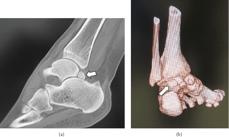 Sagittal and three-dimensional CT of an os trigonum