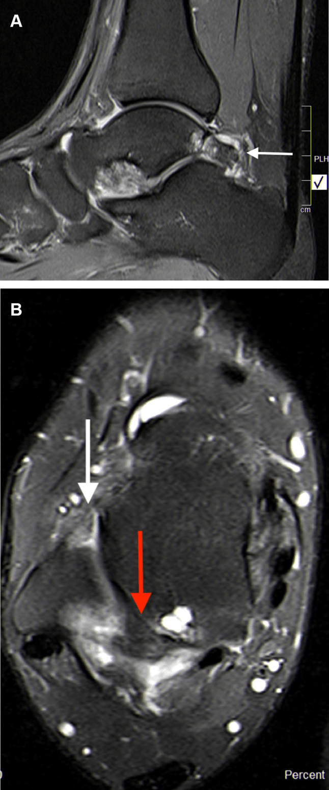 Sagittal and axial MRI showing oedema around a symptomatic os trigonum