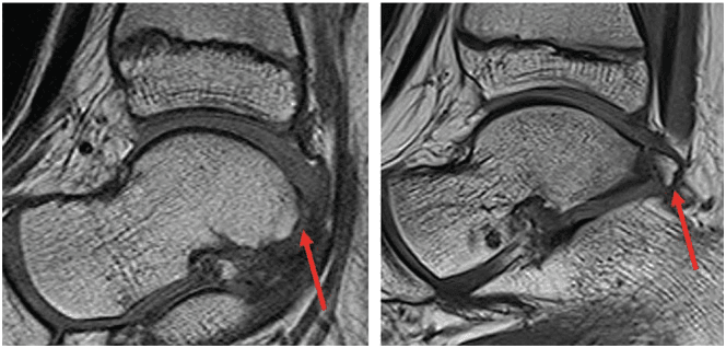 Two sagittal MRI slices of the ankle, one with an os trigonum (right panel) and one without (left panel)