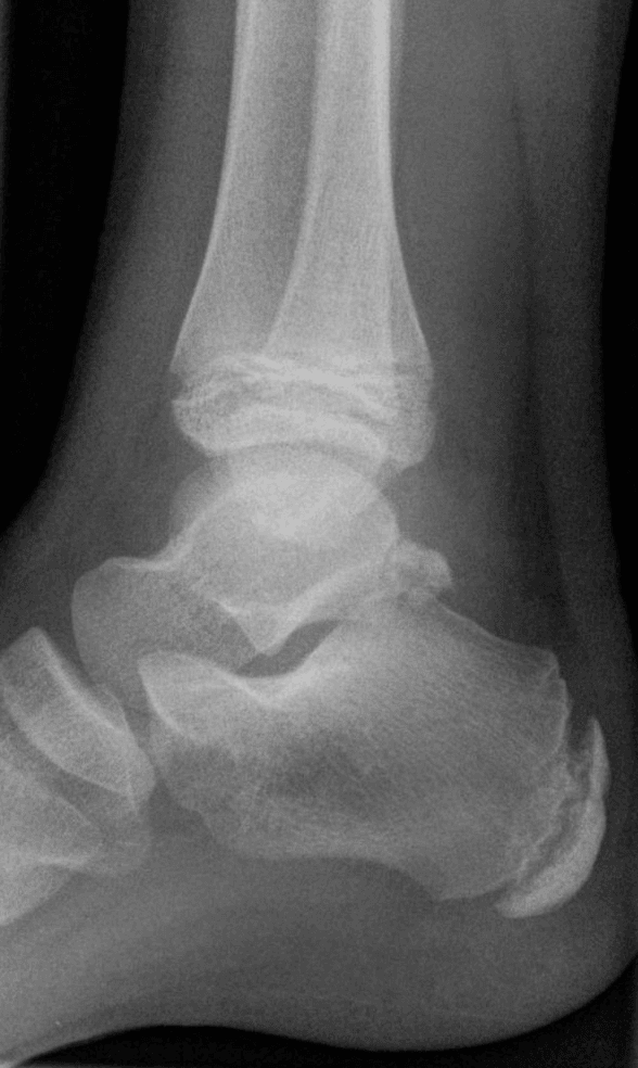 Paediatric lateral ankle radiograph showing the posterior talar ossification centre