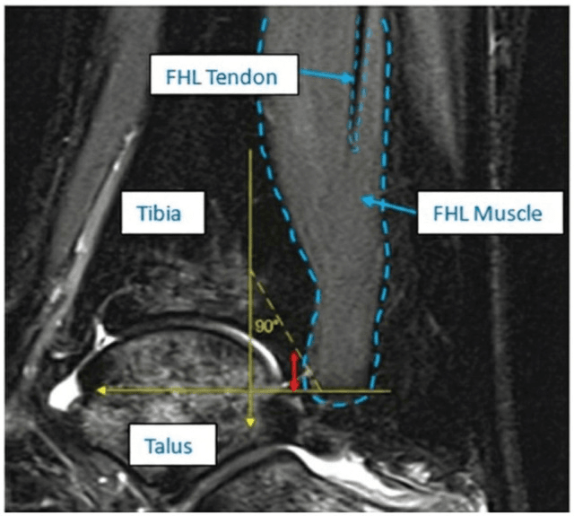 Sagittal MRI with the tibia, talus, FHL muscle and FHL tendon labelled, the muscle outlined in blue