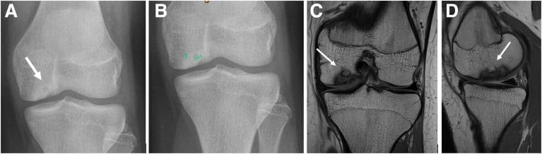 Two frontal radiographs with coronal and sagittal MRI of a medial femoral-condyle OCD lesion