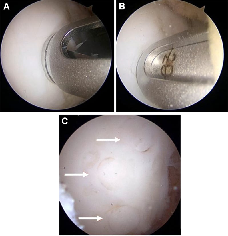 Arthroscopic preparation and implantation of mosaicplasty plugs for unstable OCD