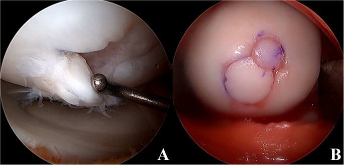 Arthroscopic views of an unstable, unsalvageable OCD fragment on the probe and the defect restored with two osteochondral autograft plugs
