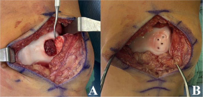 Open assessment and screw fixation of an unstable OCD fragment