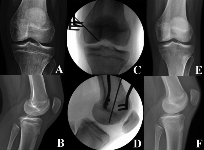Radiographic and fluoroscopic sequence of retroarticular drilling for stable juvenile OCD