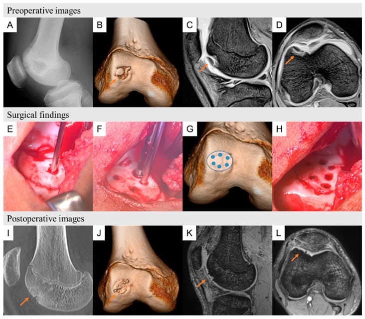 Anterior femoral-condyle OCD treated with image-guided drilling