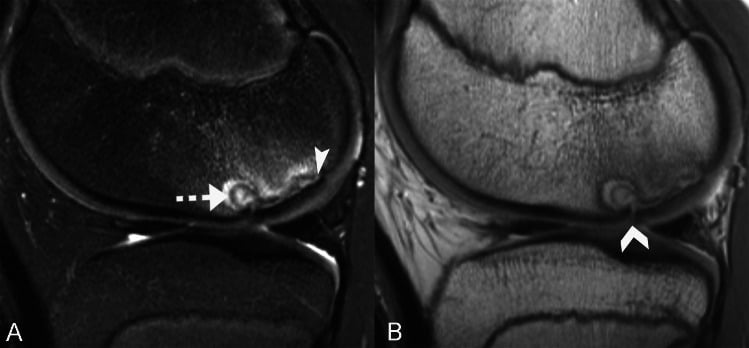 Sagittal MRI signs of an unstable femoral-condyle OCD lesion in a skeletally immature knee