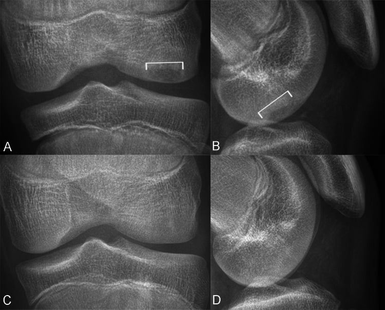Serial radiographs showing healing of a stable juvenile OCD lesion