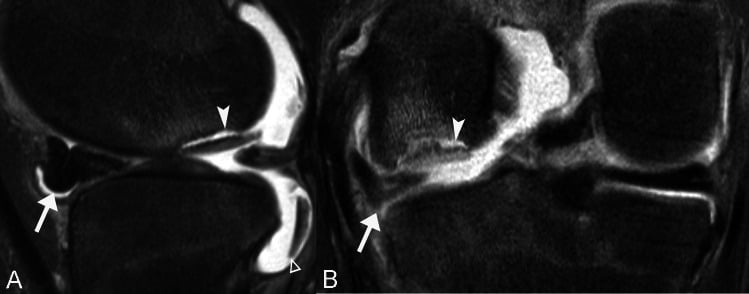 MRI in two planes showing high signal beneath a partially detached unstable OCD fragment