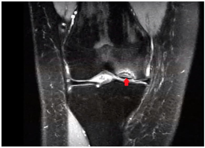 Coronal MRI showing a femoral-condyle OCD lesion beside the intercondylar notch