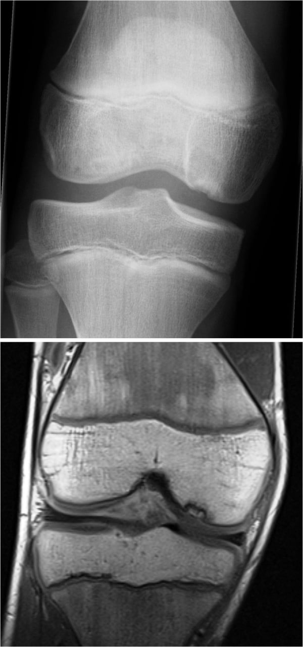 Radiograph and coronal MRI of a juvenile medial-condyle osteochondral lesion
