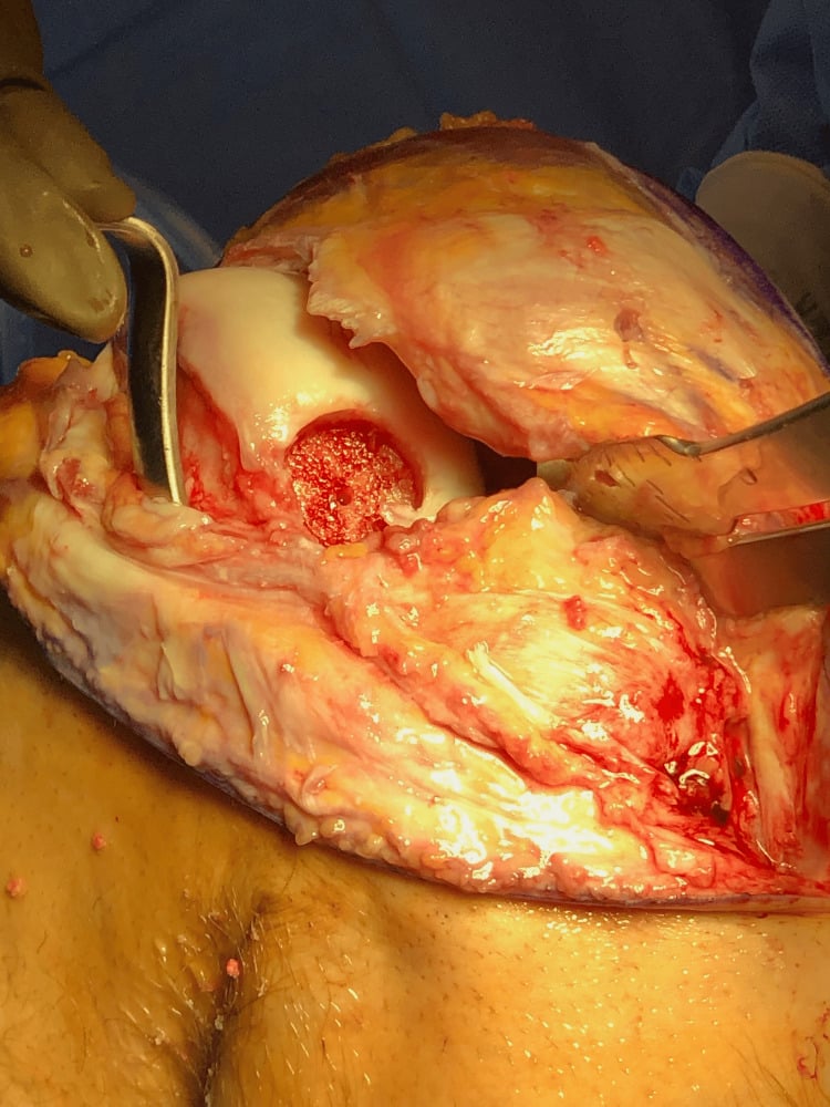 Open exposure of a large posterior lateral-condyle OCD defect