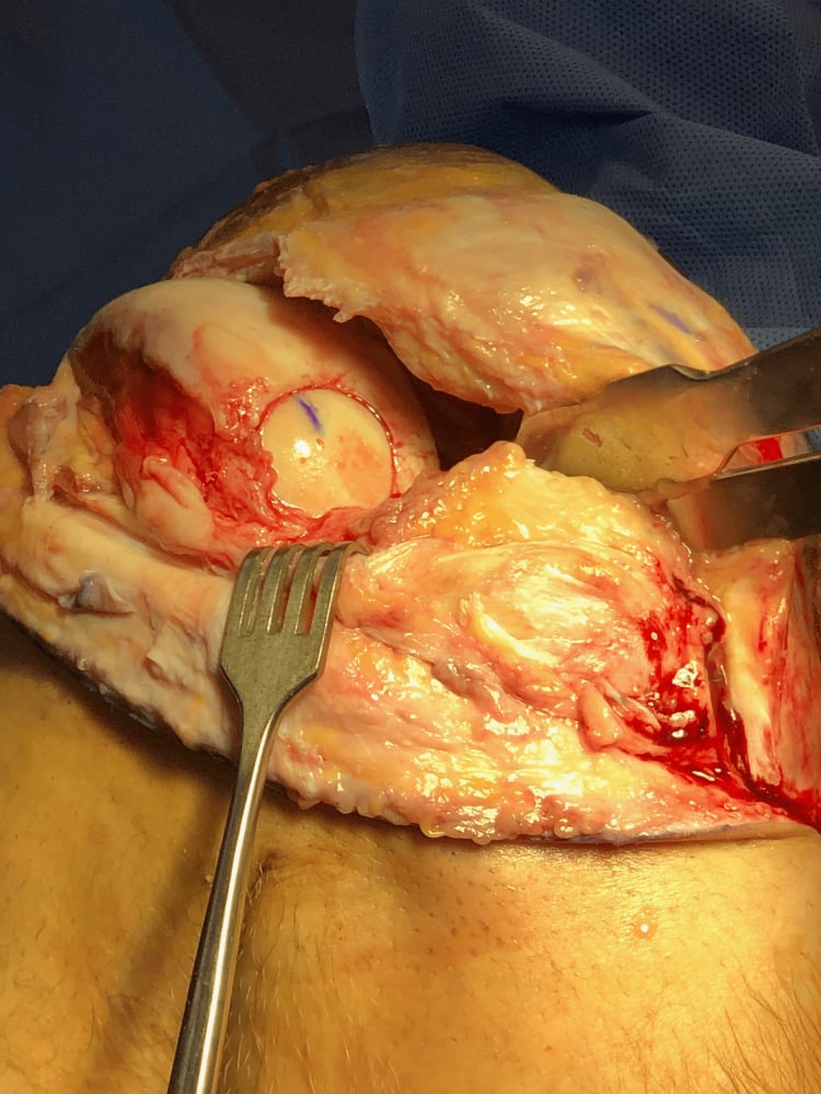 Posterior lateral-condyle OCD defect after osteochondral allograft implantation
