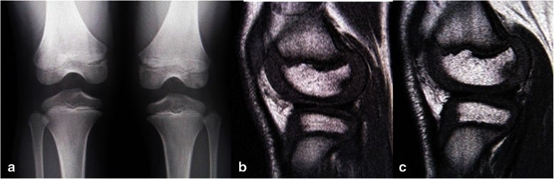 Initial frontal radiographs of both knees and sagittal MRI of juvenile OCD