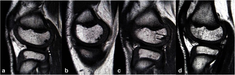 Follow-up sagittal MRI after transchondral drilling of juvenile femoral-condyle OCD