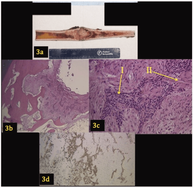 Gross and histological appearance of tibial adamantinoma with epithelial islands, panels 3a to 3d