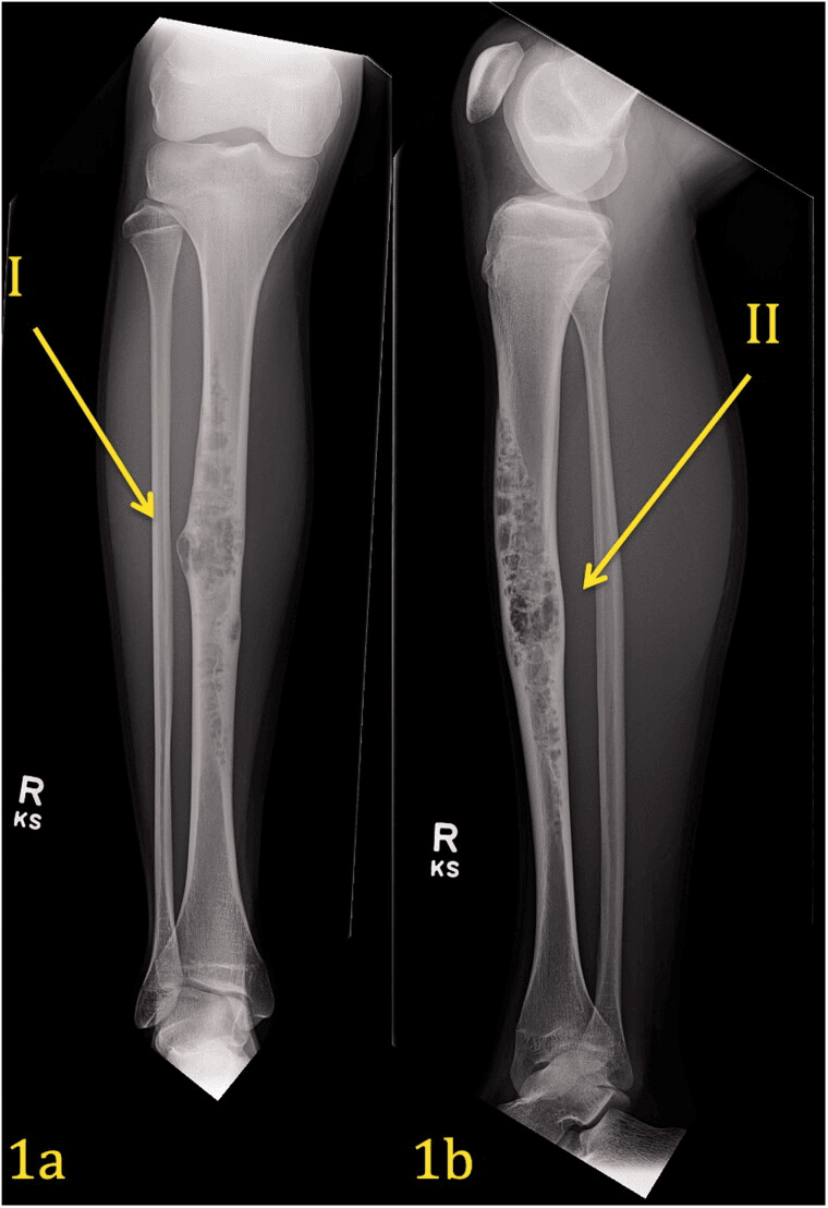 AP and lateral radiographs of tibial adamantinoma, arrows I and II