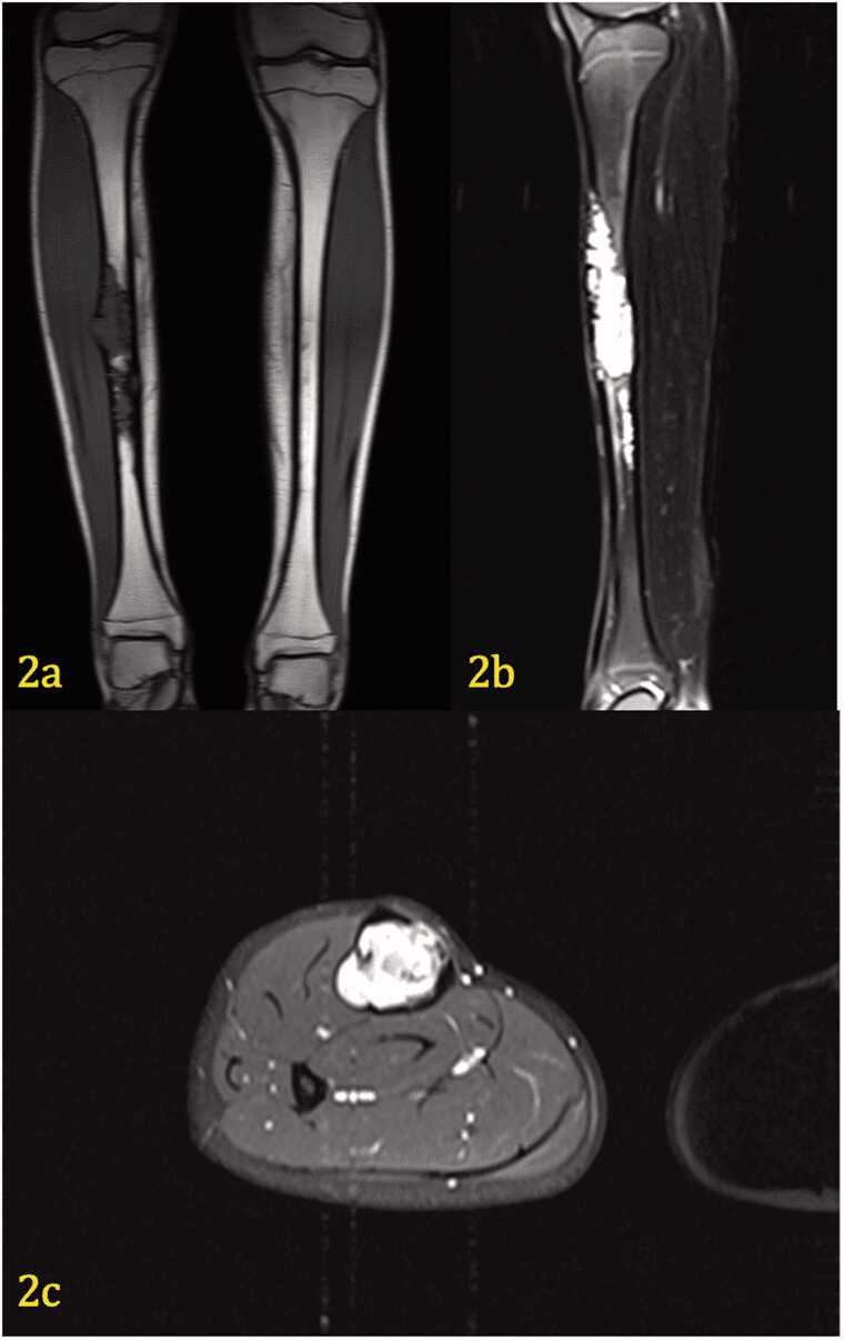 Coronal, sagittal and axial MRI showing tibial adamantinoma with a soft-tissue component