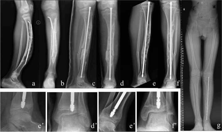 Serial radiographs, panels a to g, of corrective osteotomy and telescopic nailing for severe anterior tibial bowing in osteofibrous dysplasia