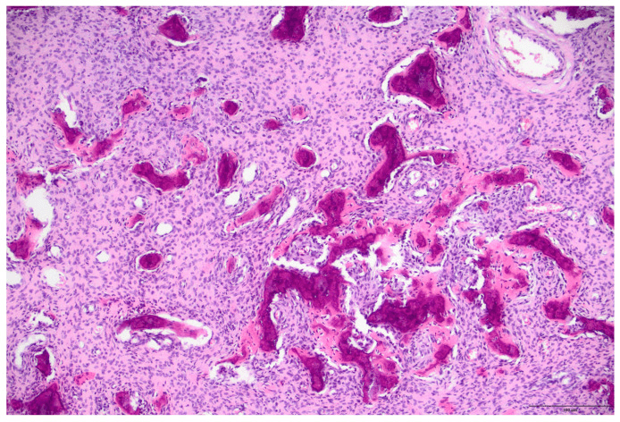 Histology of fibrous dysplasia with curvilinear woven bone and a 100 micrometre scale bar