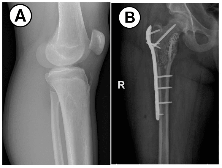 Radiographs of fibrous dysplasia: lateral knee with a proximal tibial lesion (A) and a plated proximal femur (B)